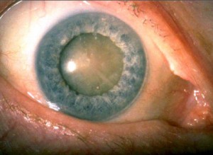 mature cataract