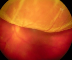 retinopathy of prematurity aao